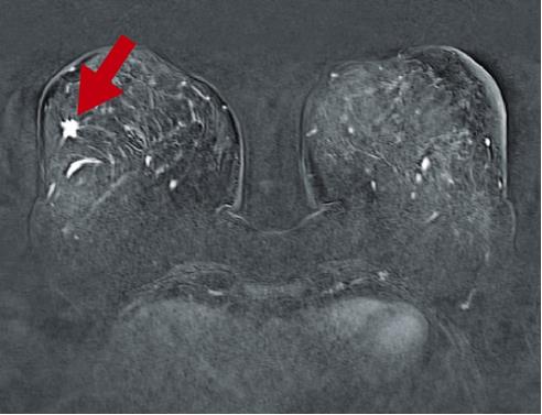 Gewebe in brust dichtes der MRI Brust